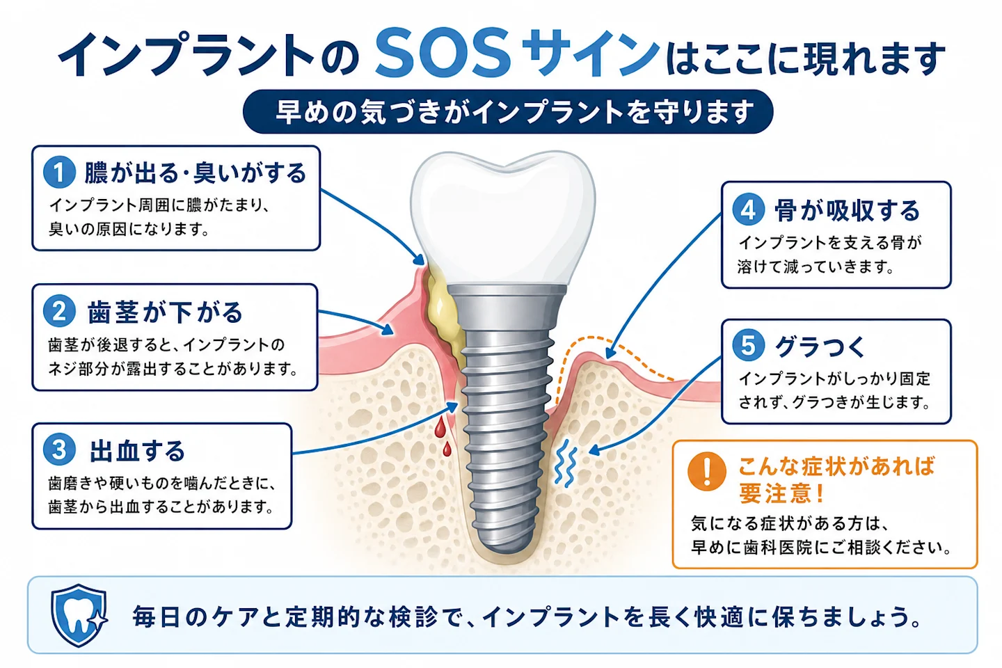 インプラントに膿・臭い・歯茎下がる・出血・グラつきの症状が現れる位置を示した断面図