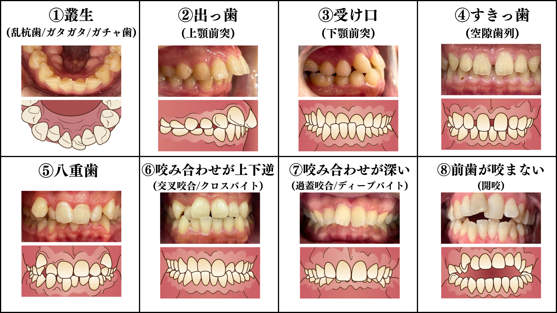不正咬合の種類