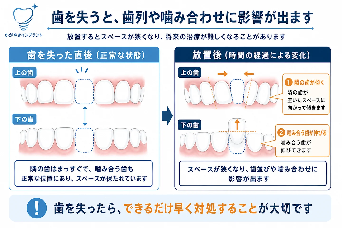 歯を失った直後と放置後の歯列を比較し隣の歯の傾斜と対合歯の挺出でスペースが狭くなった様子を示す図
