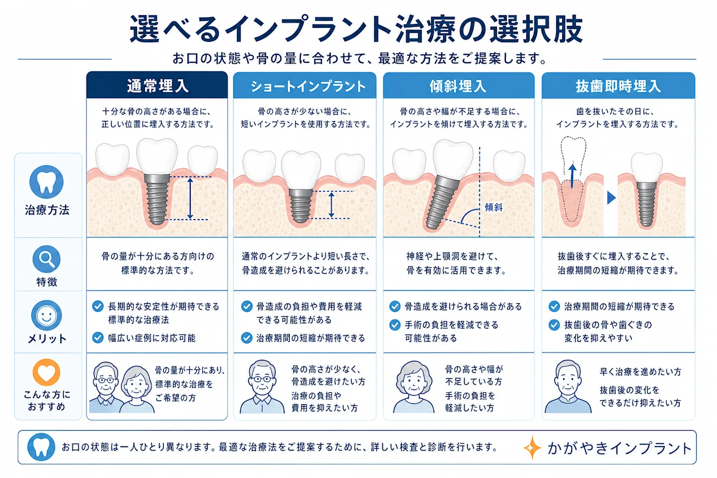 ショートインプラント・傾斜埋入・抜歯即時埋入と通常埋入を比較した図解