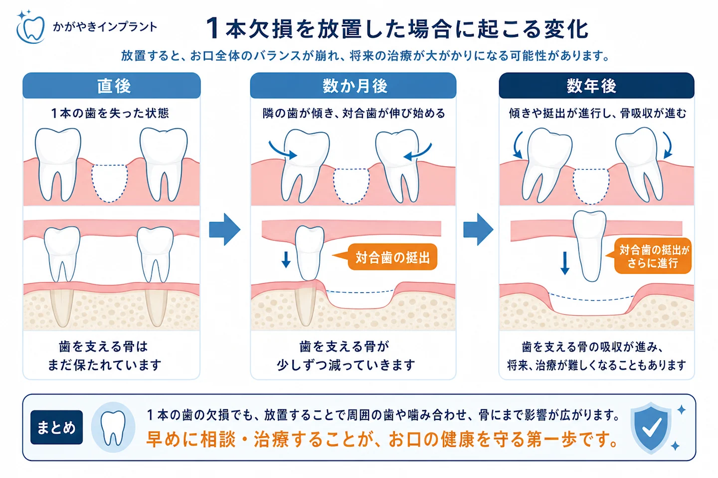 1本の歯を失って放置した場合に起こる隣の歯の傾きと対合歯の伸びを示す図