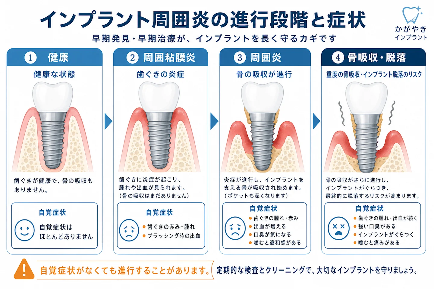 インプラント周囲炎の進行段階と各段階の症状を示した断面イラスト
