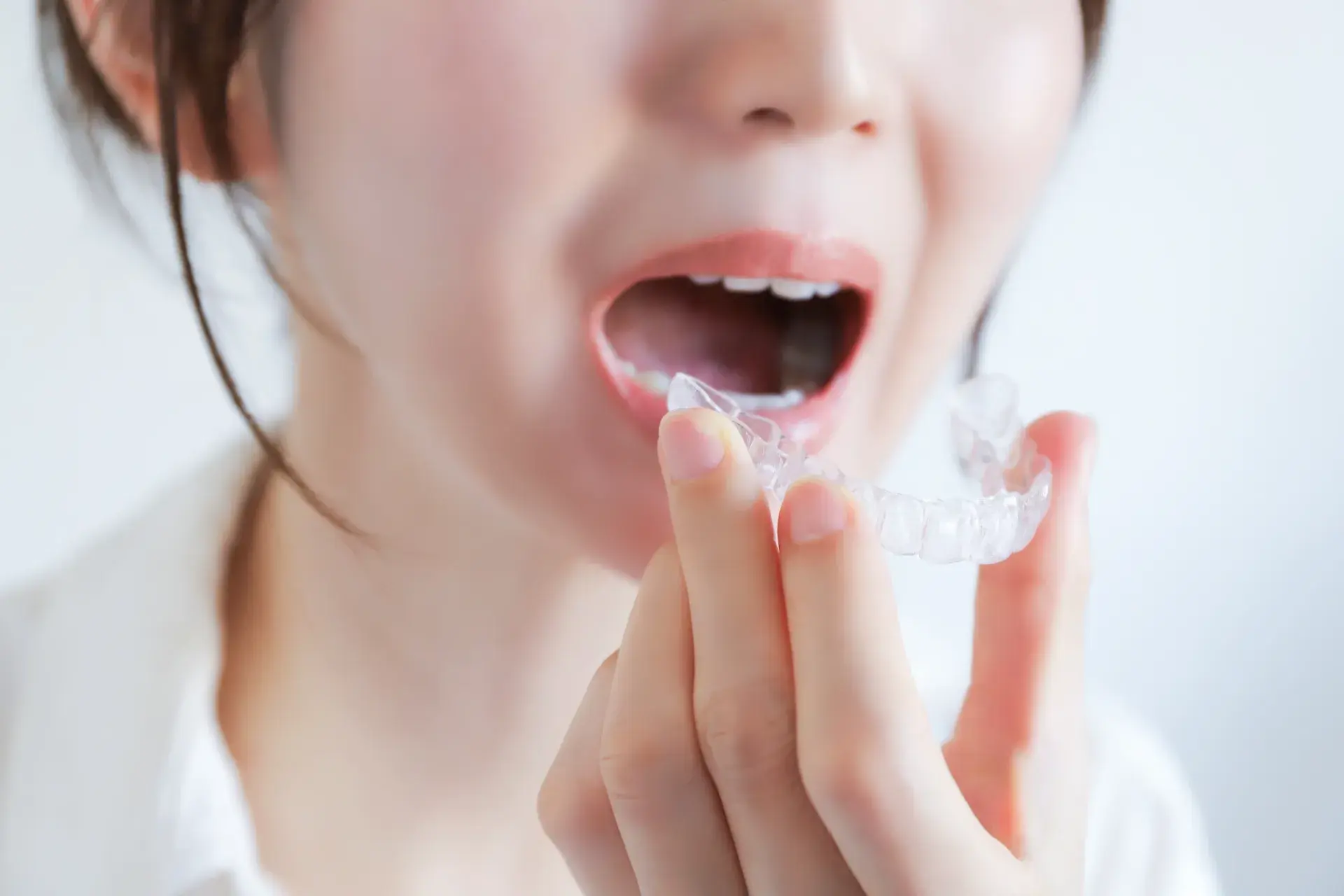 口元のお悩みなら、スマイルモア矯正