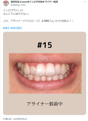インビザラインが目立たない口コミ