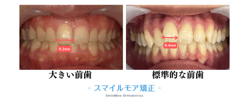 大きい前歯と標準的な前歯の比較画像