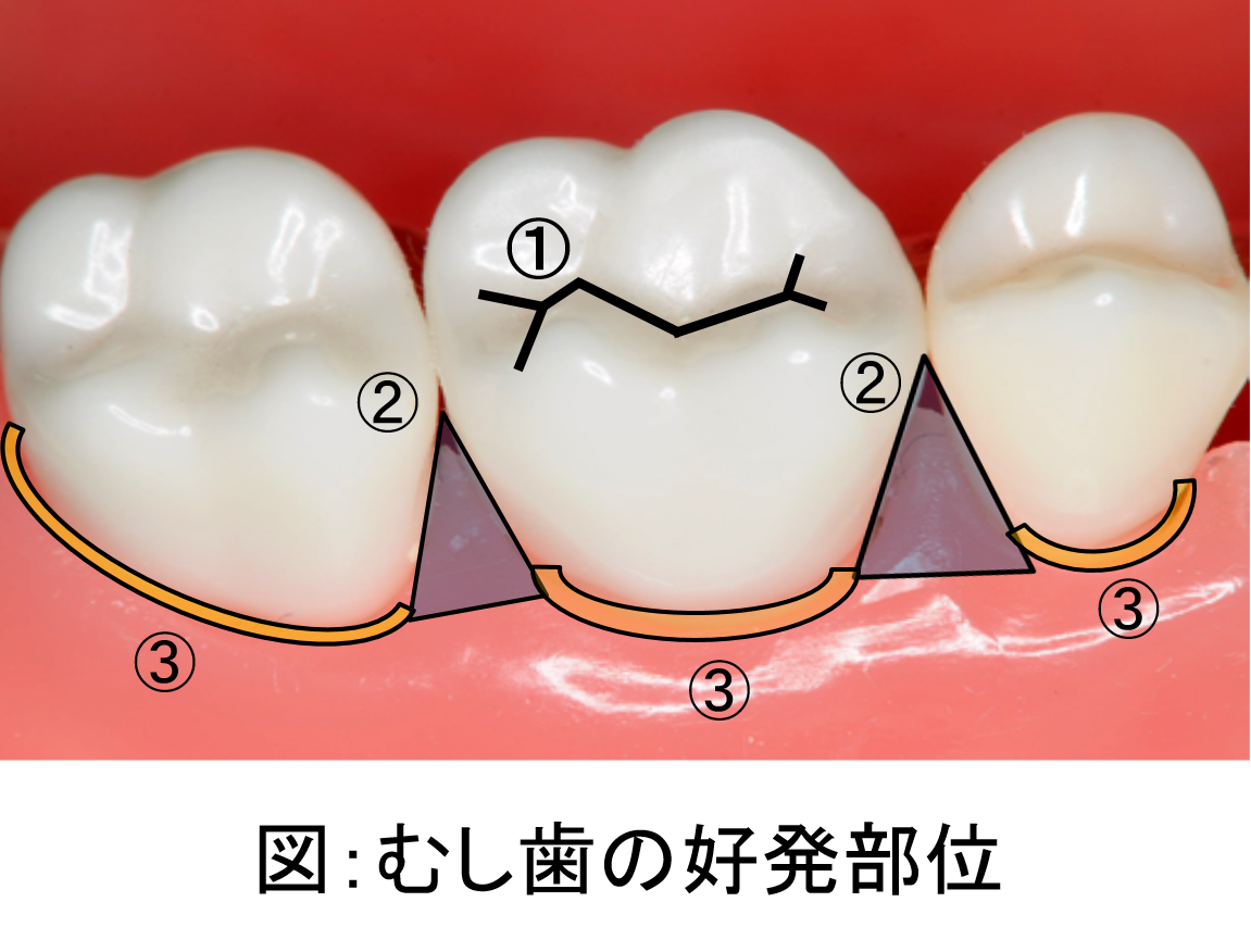 虫歯の3大好発部位