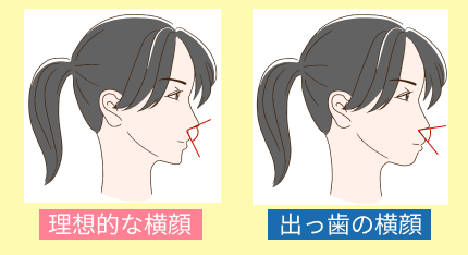 理想的な横顔と出っ歯の横顔の比較