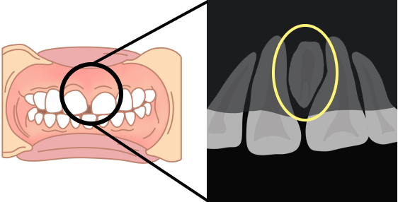 過剰歯の埋伏