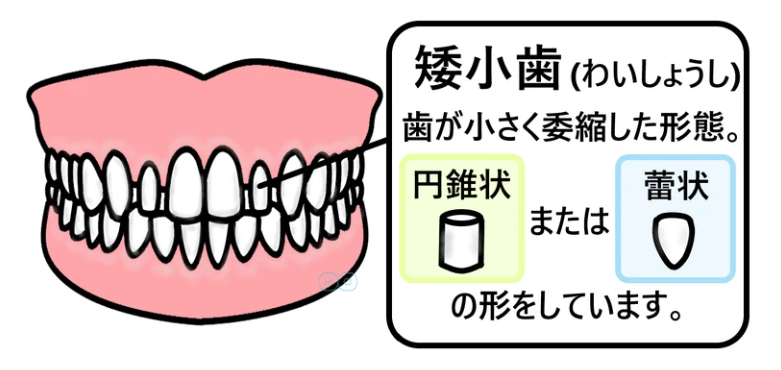 矮小歯とは