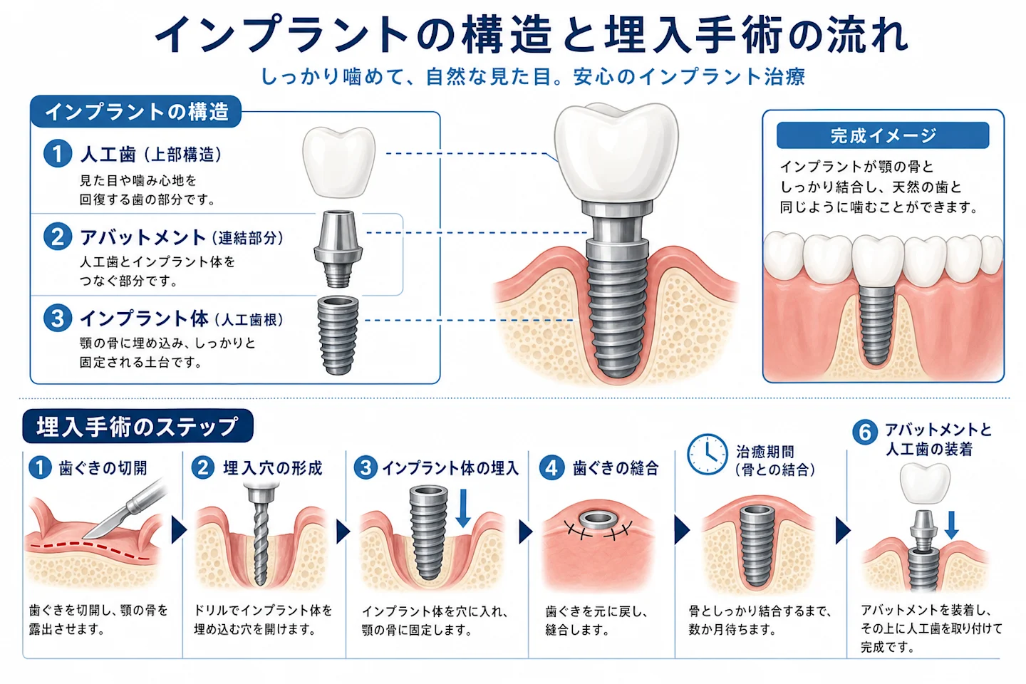 インプラントの構造と埋入手術を示す断面図(インプラント体・アバットメント・人工歯)