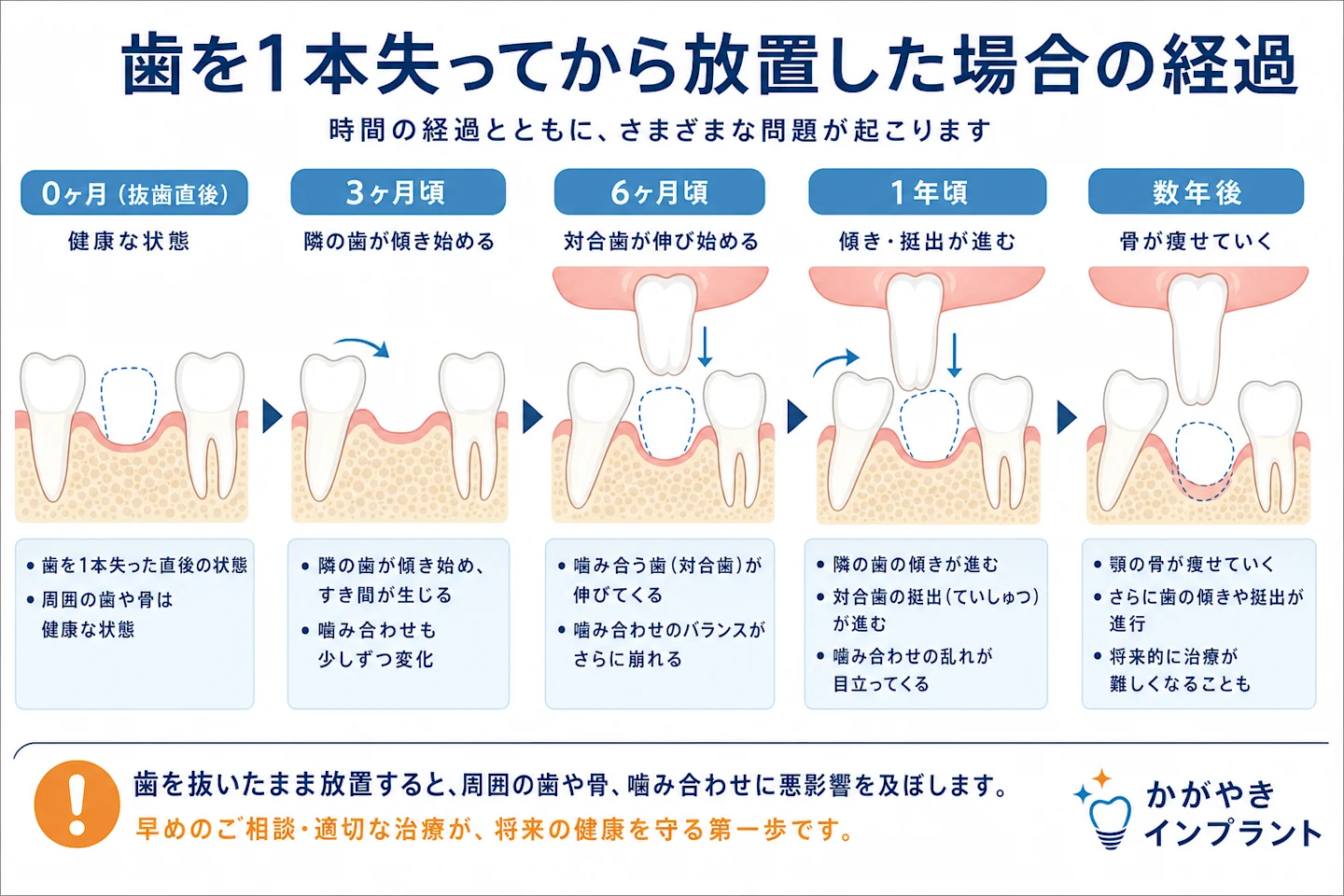 歯が抜けたまま放置すると隣の歯が傾き噛み合う歯が伸び顎の骨が痩せていく経過を示した図
