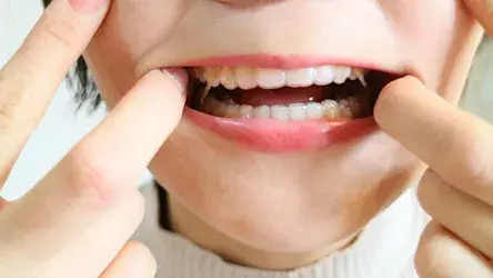 歯が二列になる二重歯列の要因と治療方法など徹底解説