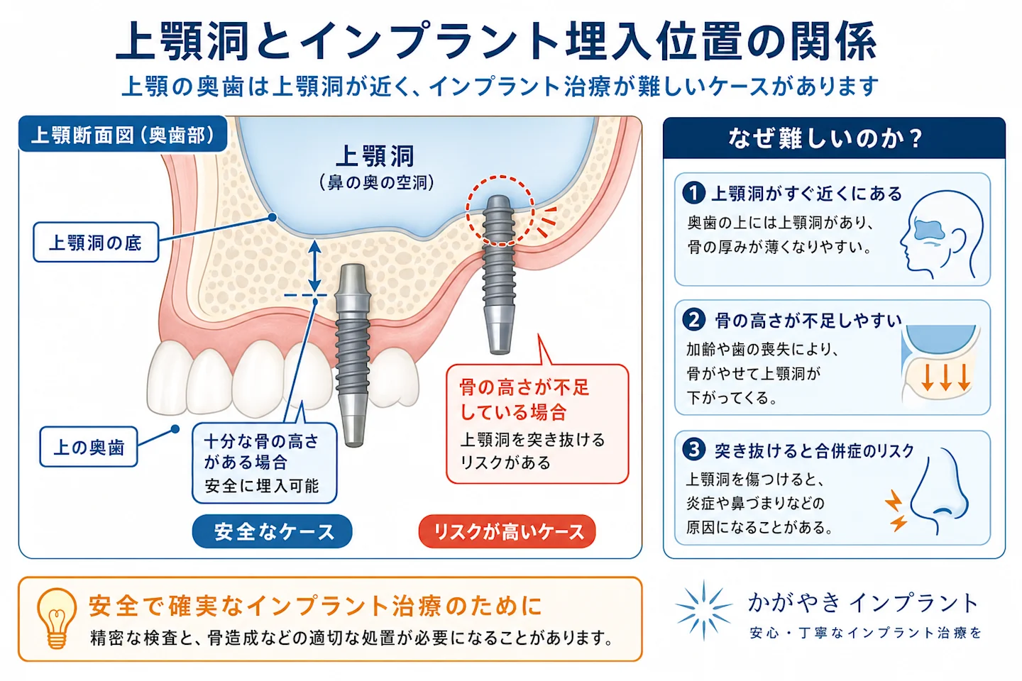上顎洞とインプラント埋入位置の関係を示す上顎断面の解説図