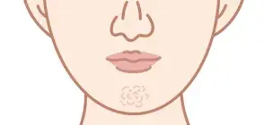 顎に梅干しのようなしわができる