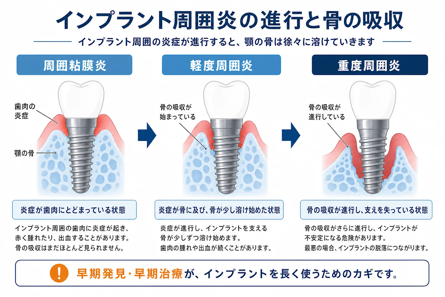 インプラント周囲炎が進行して顎の骨が徐々に溶けていく3段階の進行図