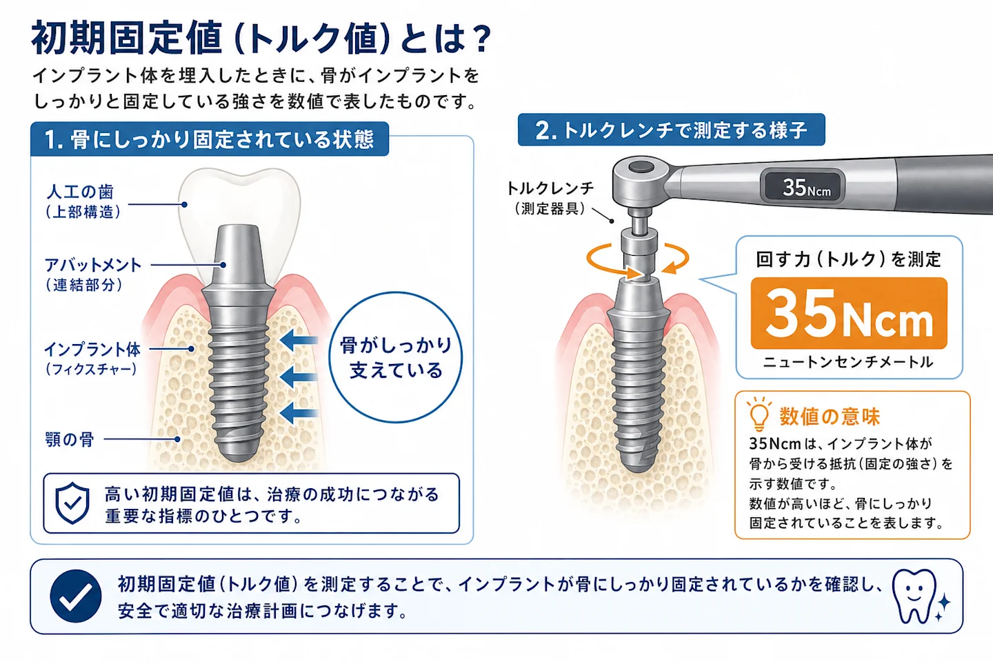 インプラント初期固定値35Ncmを測定する仕組みと骨内固定を示した断面イラスト