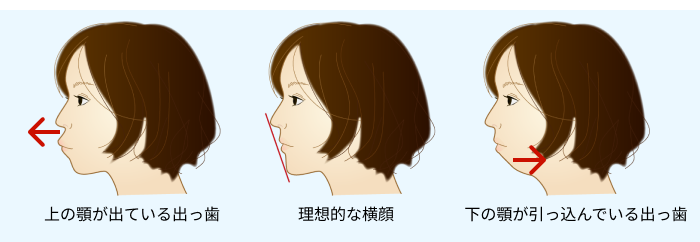 上下の顎の骨の位置の違いによる横顔比較