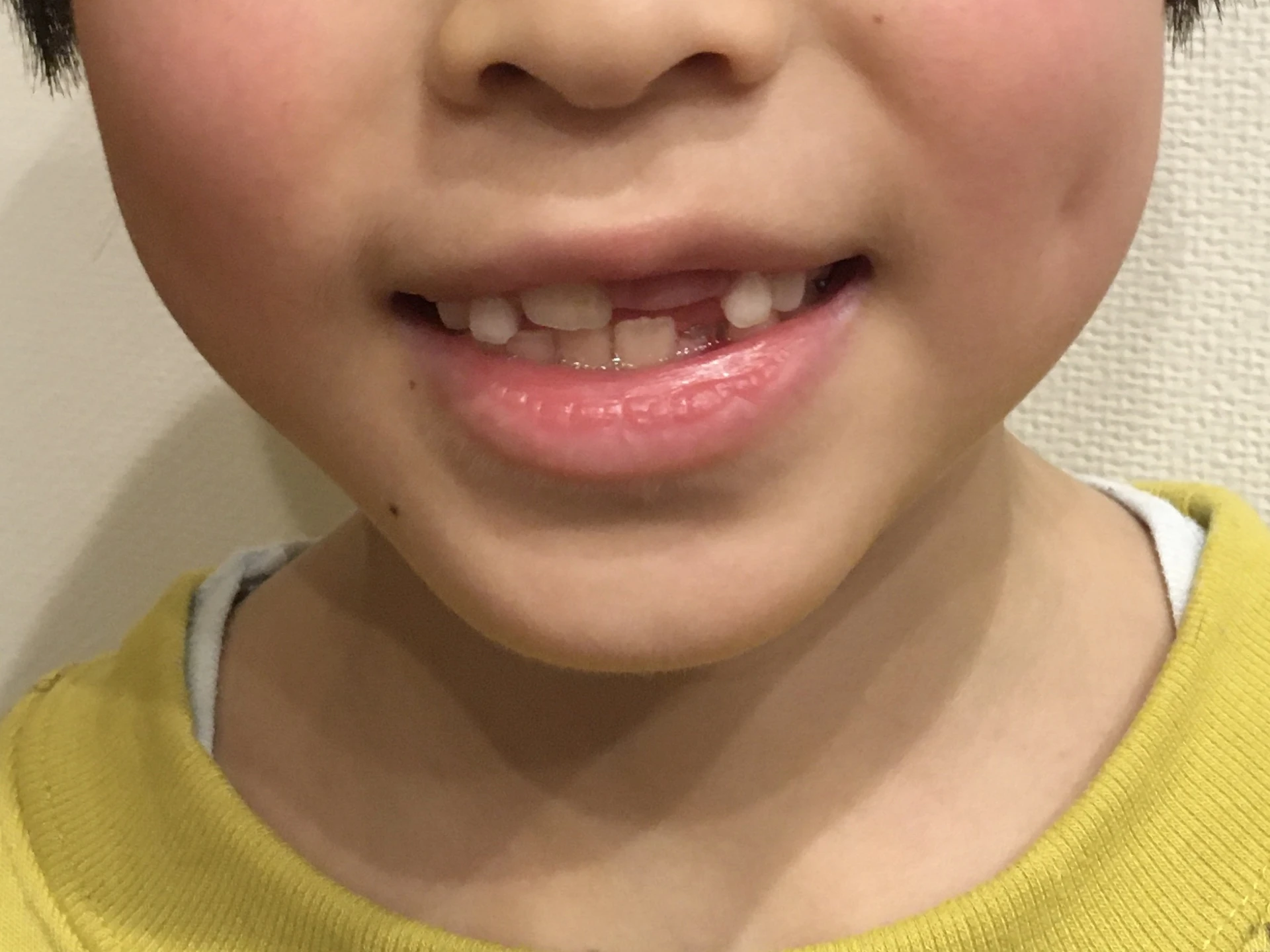 歯の隙間を埋める方法は？原因や詳しい治療法を解説