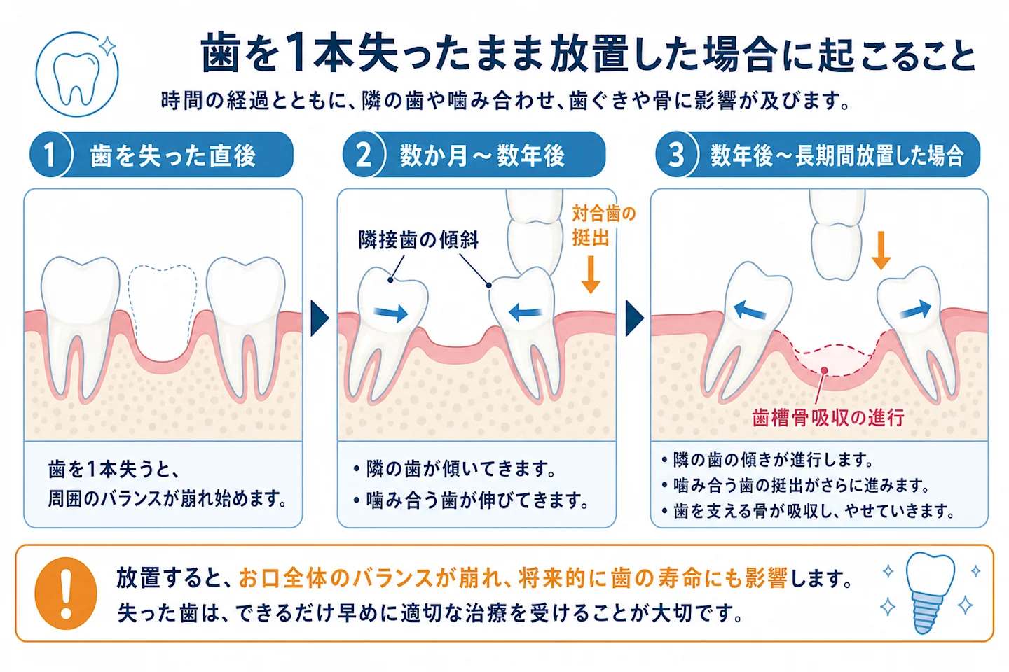 歯を失ったまま放置した場合に起こる隣の歯の移動と骨吸収のイメージ図