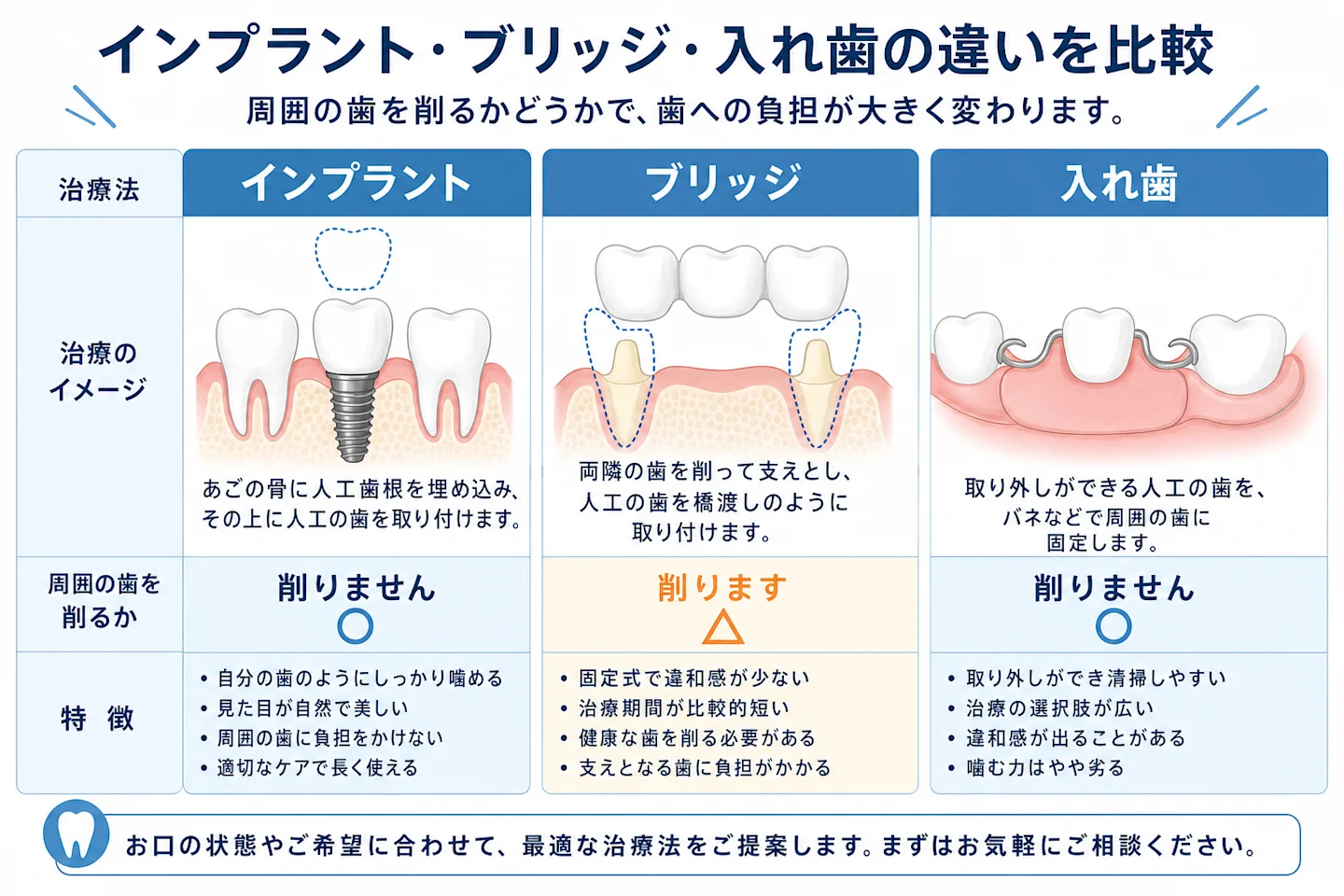 インプラント・ブリッジ・入れ歯の違いを比較した図解イラスト