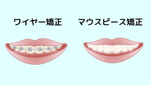 ワイヤー矯正とマウスピース矯正の比較イラスト