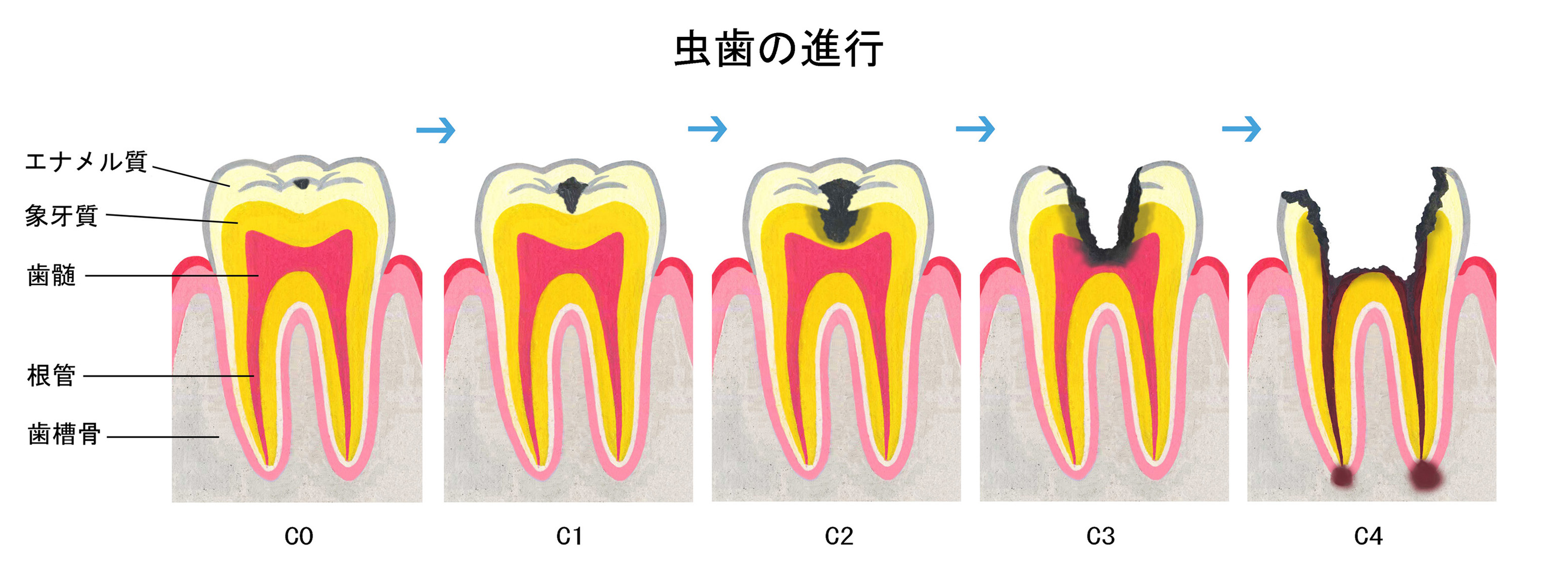 虫歯の進行