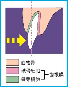 歯列矯正のメカニズム