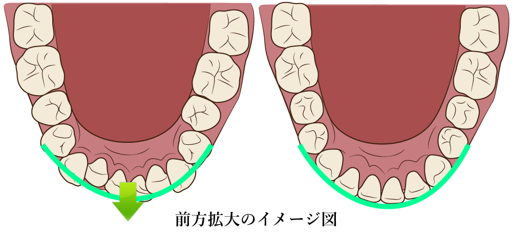 前方拡大のイメージ図