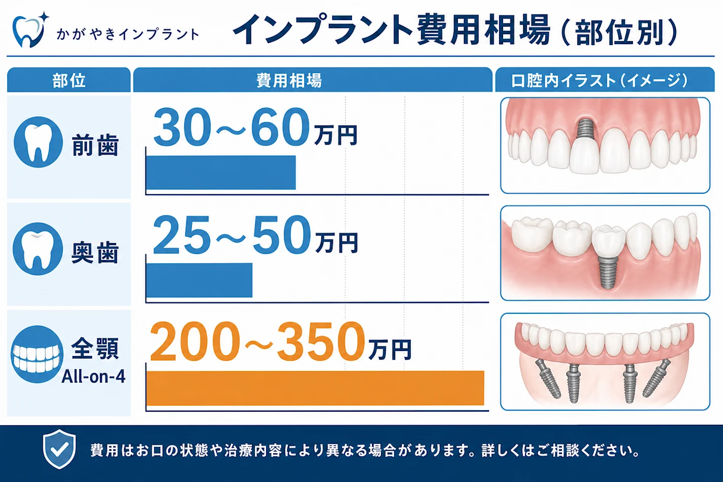 インプラント費用相場の部位別比較（前歯30〜60万円・奥歯25〜50万円・全顎200〜350万円）