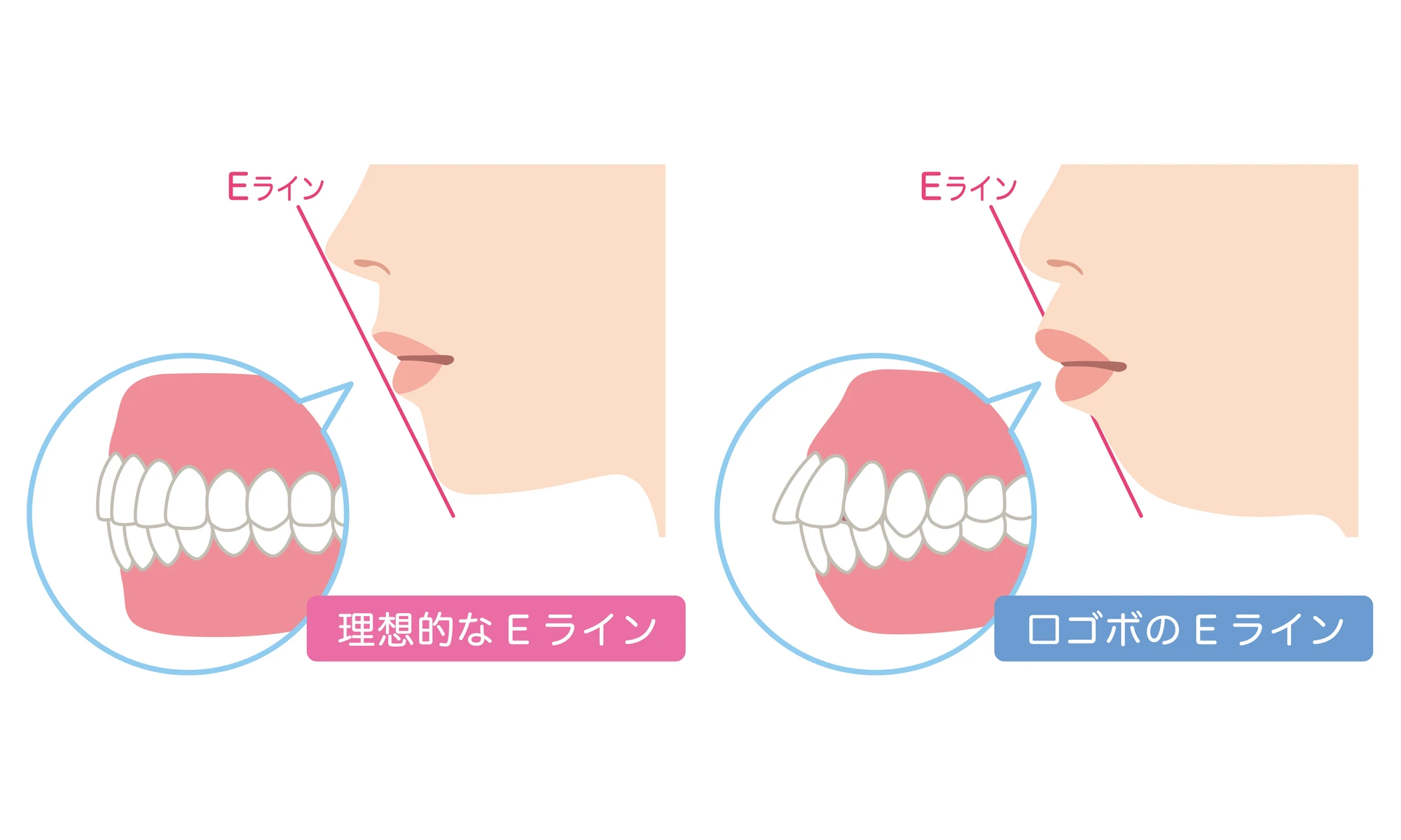 そもそも口ゴボとは