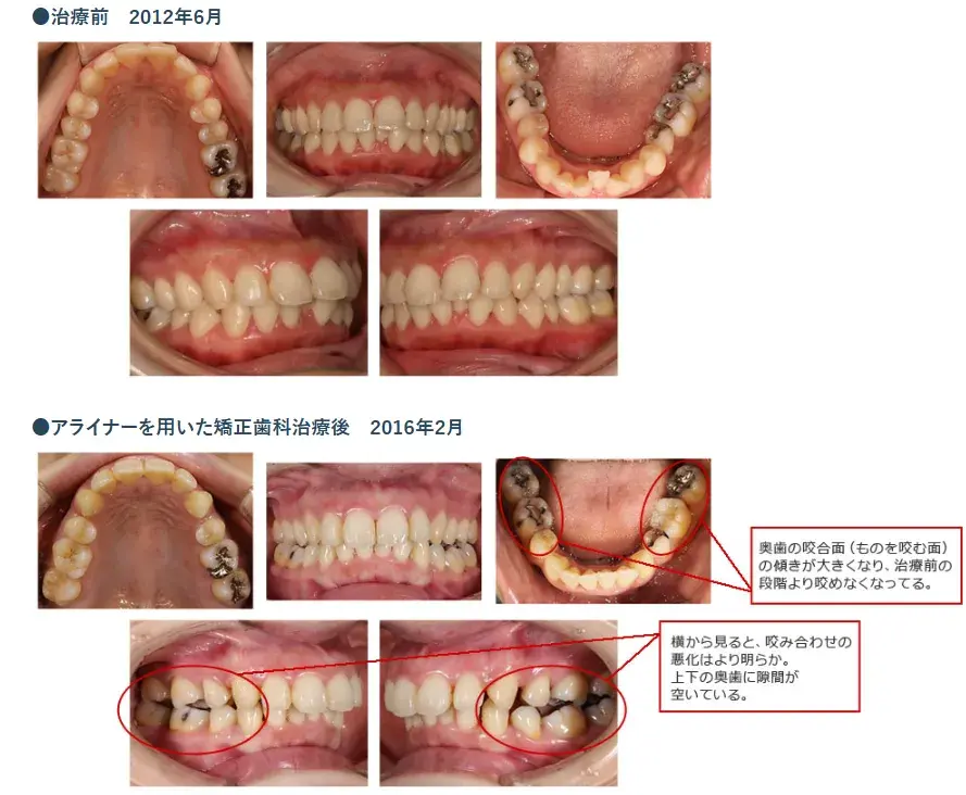 不適切なマウスピース使用例