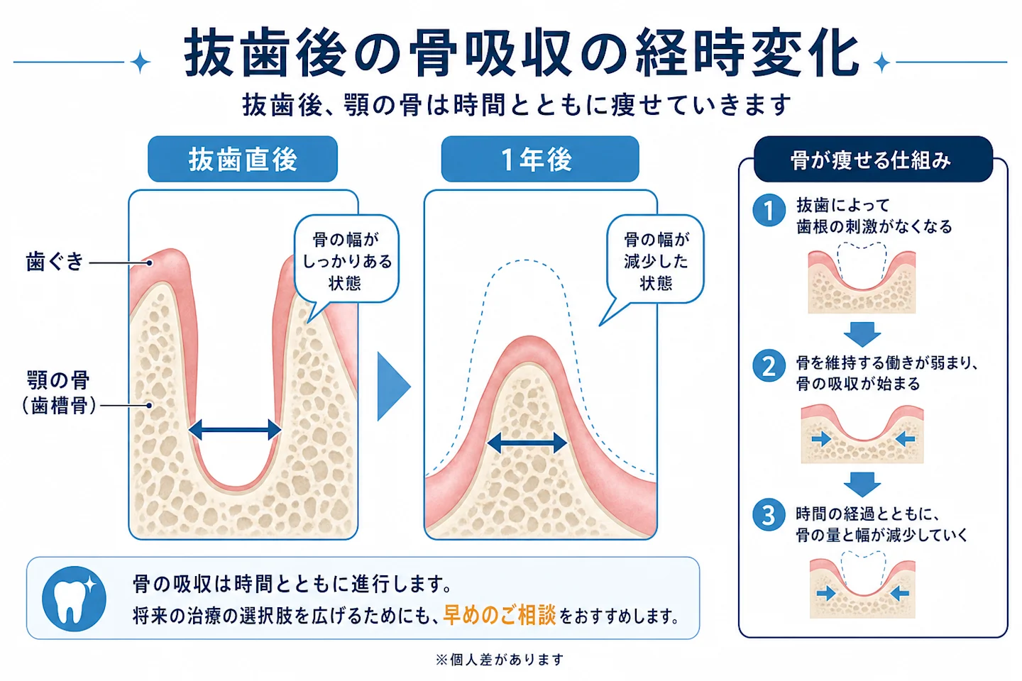 抜歯後に顎の骨が痩せていく骨吸収の経過を示すビフォーアフター図