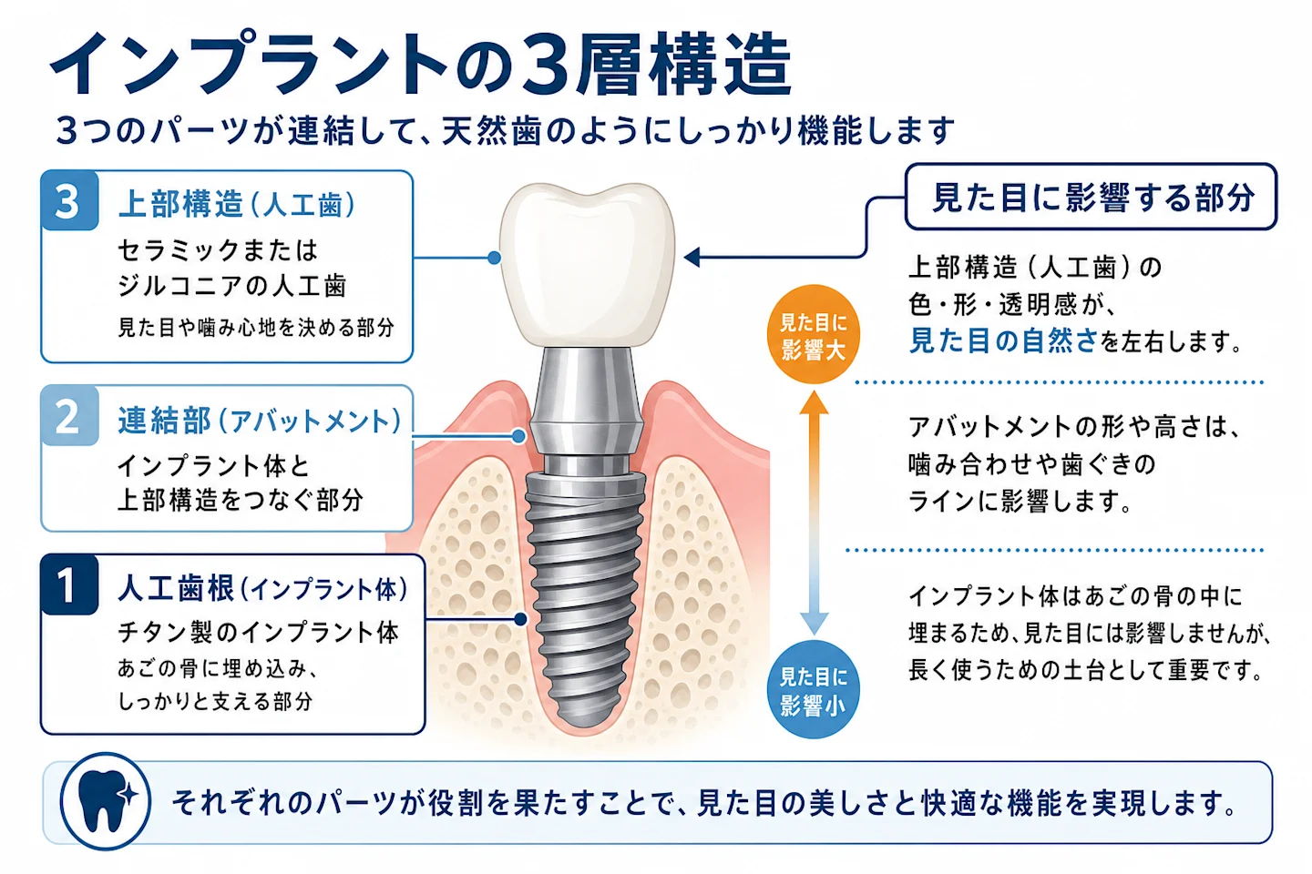 インプラントの構造(インプラント体・アバットメント・上部構造)を示す断面図