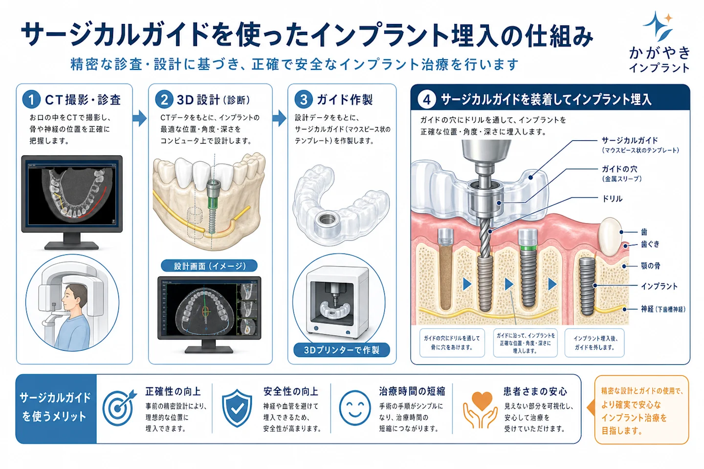 サージカルガイドを使ったインプラント埋入の仕組みを示す断面図解