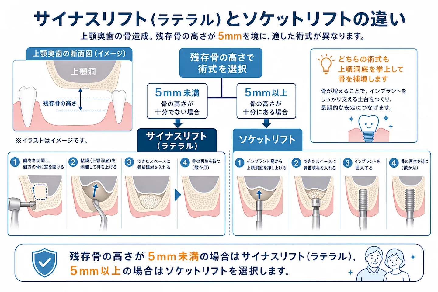 上顎奥歯の骨造成におけるサイナスリフトとソケットリフトの違いを示す模式図