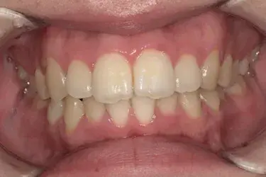 Before Image