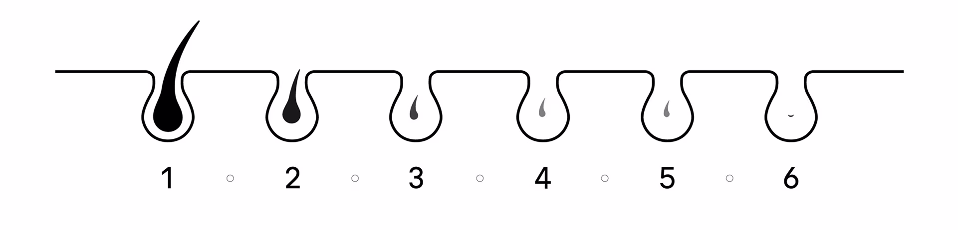 Gráfico que muestra el vello entre la primera y la sexta sesión, de manera que se aprecia la reducción del vello visible. Gráfico que muestra el vello entre la primera y la sexta sesión, de manera que se aprecia la reducción del vello visible.
