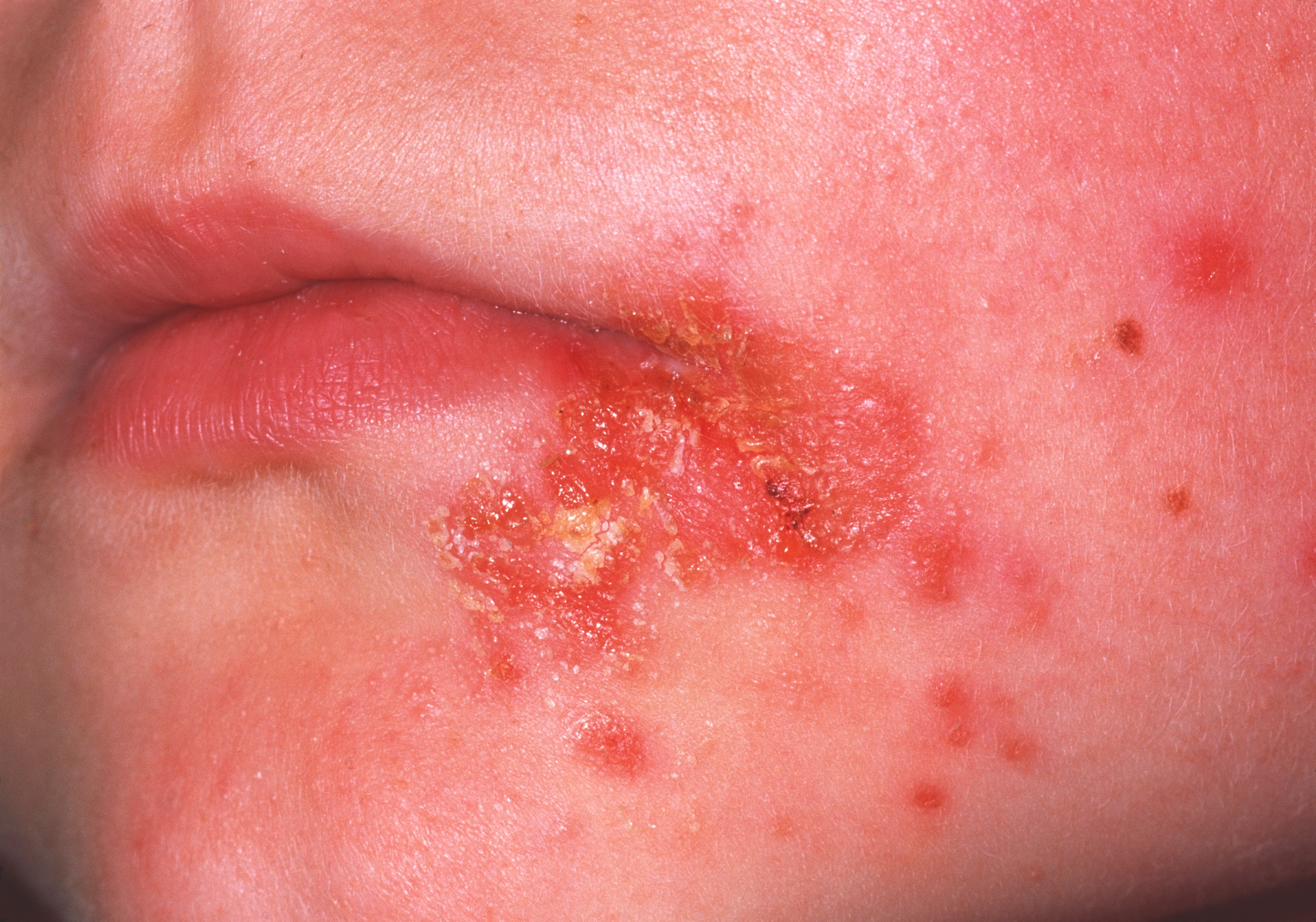 Rise in Kids Visiting Doctors with Acne, More Mysterious Symptoms Reported