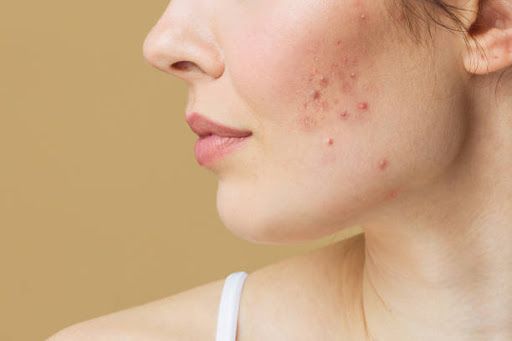 Does Dairy Cause Acne