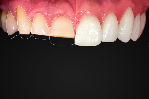 Aplicação de lentes de contato dental em Brasília