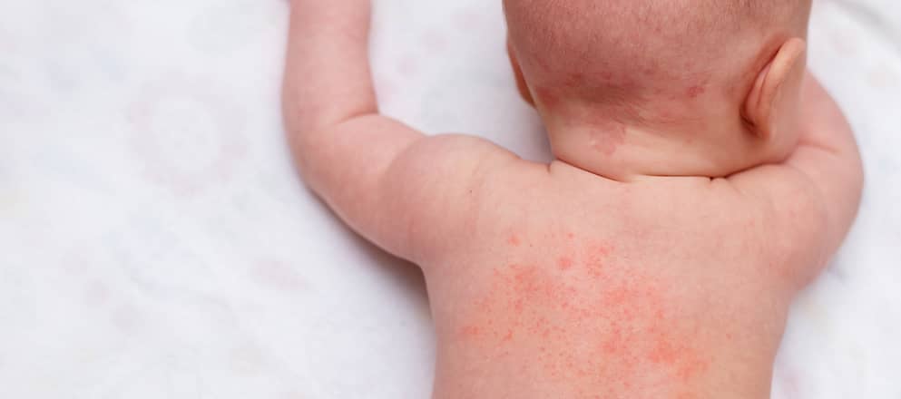 Baby met warmte-uitslag op rug, miliaria