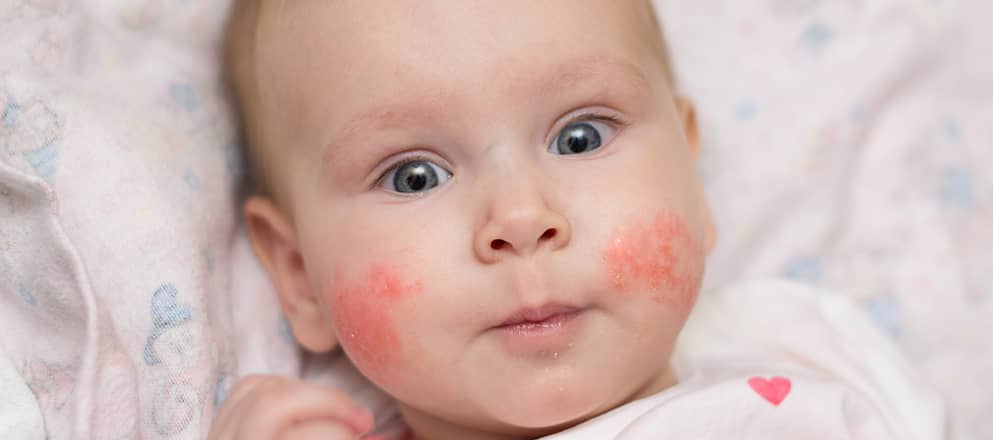 Baby met eczeem op de wangen
