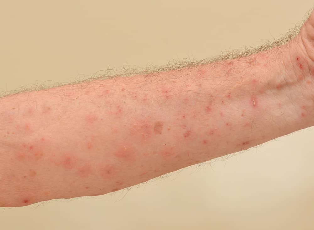 arm met schurft