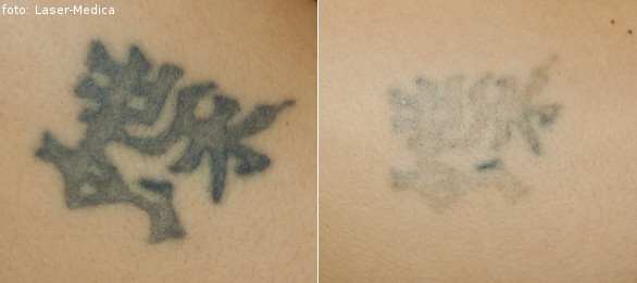 usuwanie tatuażu - efekty