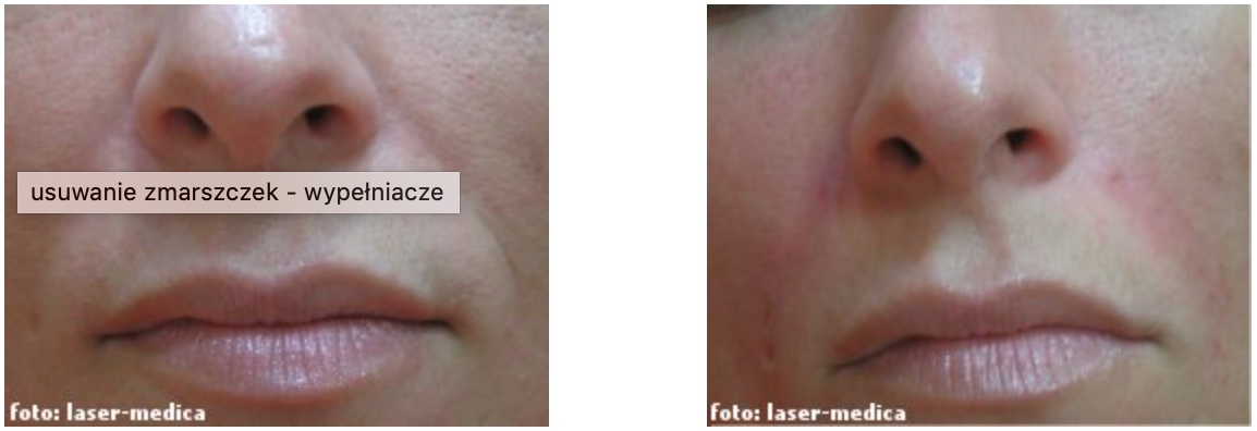 kwas hialuronowy - efekty, korekcja bruzd nosowo-wargowych