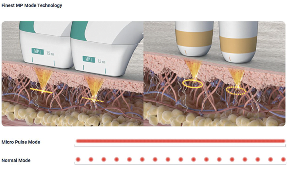 Ultraformer - działanie