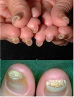 Zgrubienie paznokci (pachyonychia)