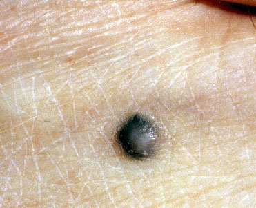 Znamię błekitne (blue nevus)