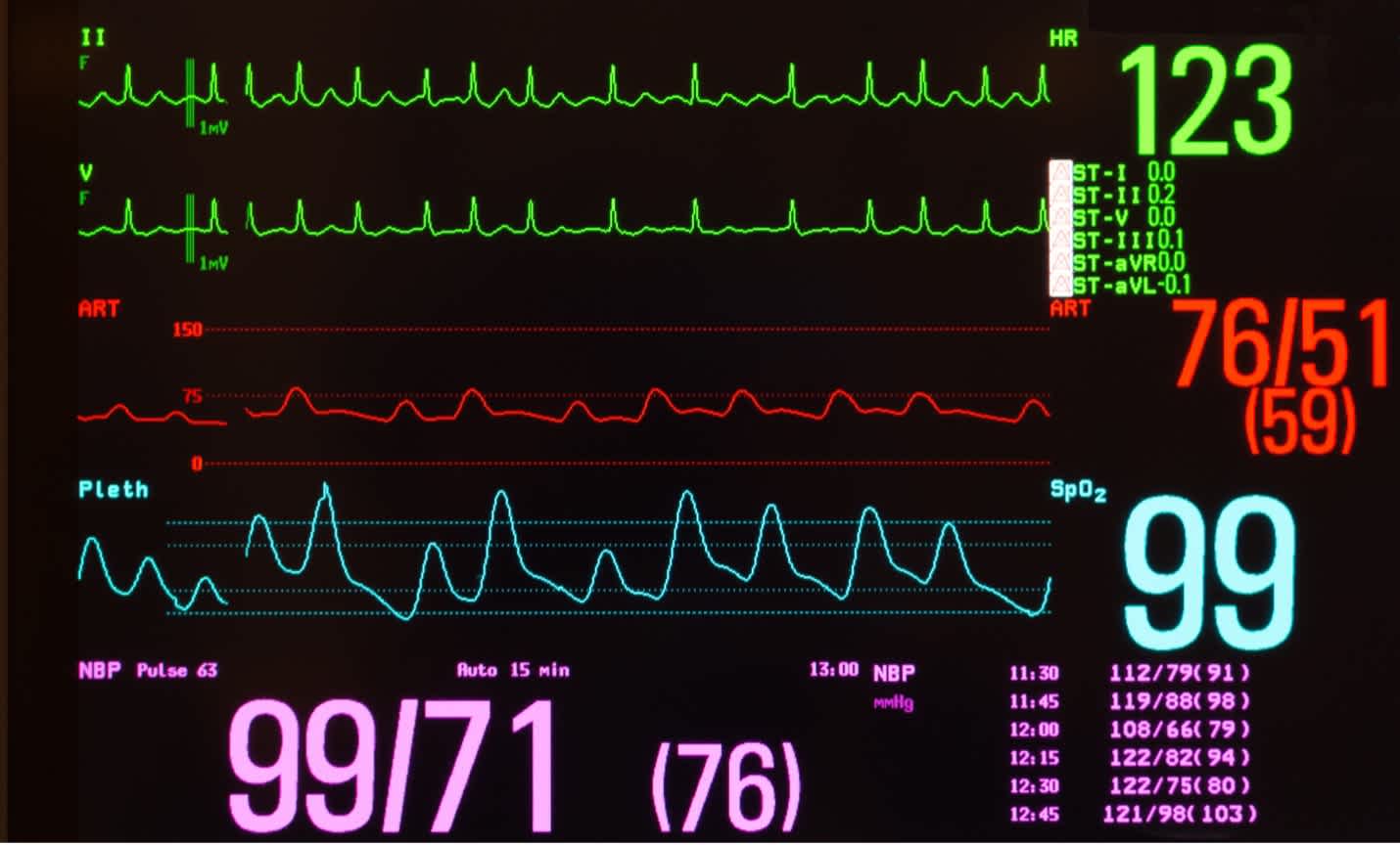 ECG Screen