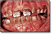 Discolored Teeth - Figure 7